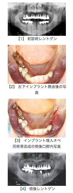 骨結合型インプラント