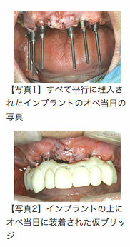 平行なインプラント埋入