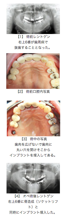 骨造成フラップレス埋入症例